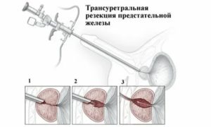 Удаление мочевого пузыря у мужчин при раке предстательной железы