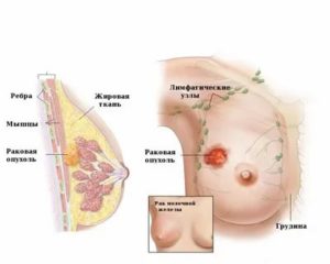 Может ли при раке молочной железы болеть спина