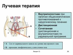 Сколько живут при раке шейки матки после лучевой терапии