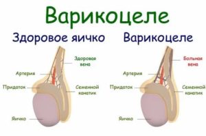 Что делать если после операции варикоцеле увеличилось яичко