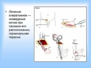 Как делают операцию по низведению яичка