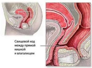 Кому делали операцию по ректовагинальному свищу