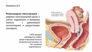 Что такое ретроградными менструациями