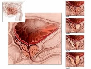 Лечение солью аденомы предстательной железы профессор окулов