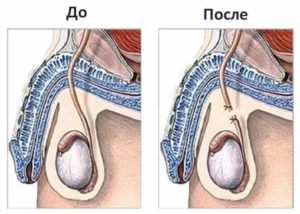 Какую операция делают мужчинам на половом органе