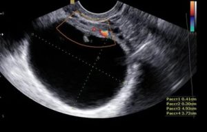 Жидкость в правом яичнике на узи что значит