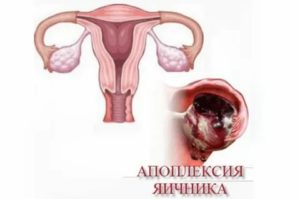 Можно ли забеременеть после операции апоплексии яичника