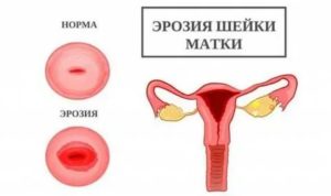 Диагностика эрозии шейки матки девственниц