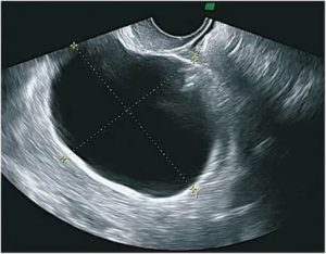 Как выглядит цистаденома яичника на узи