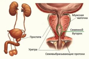 Киста семенного бугорка предстательной железы