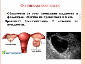 Что значит персистирующая киста яичника