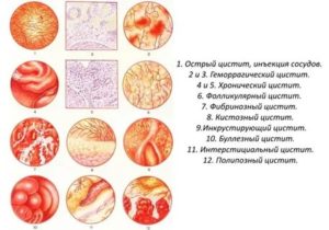 Чем лечить фолликулярный цистит