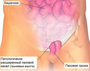 Диагностика паховой грыжи у мужчин к какому врачу обратиться