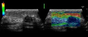 Узи молочных желез с допплерографией и соноэластографией