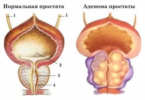 Смешанная гиперплазия предстательной железы с очаговой пин