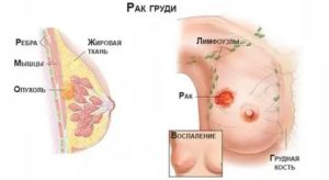 Может ли быть у мальчика рак молочной железы