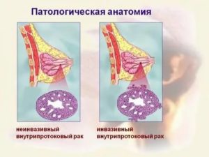 Инвазивный и неинвазивный рак молочной железы в чем отличия