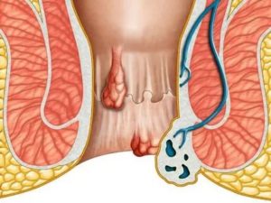 Может ли геморрой спровоцировать цистит