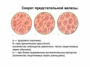 Забор секрета предстательной железы отзывы