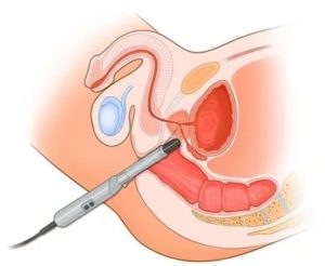 Как подготовиться к пункции предстательной железы
