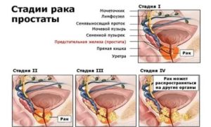 Лечение рака простаты в германии стоимость полная
