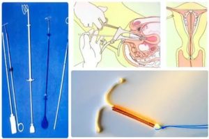 Может ли сама выпасть внутриматочная спираль