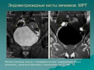 Зачем делать мрт при кисте яичника