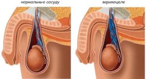 Что делать если после операции варикоцеле болит яичко у