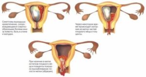 Сколько дней идут месячные после выкидыша на раннем сроке