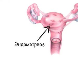 Эндометриоз при раке шейки матки