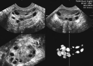 Что такое мультикистоз яичников и как его лечить