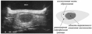 Узи молочных желез анэхогенные включения