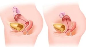 Как проходит операция при выпадении матки в пожилом возрасте