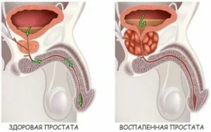 После массажа простаты затрудненное мочеиспускание