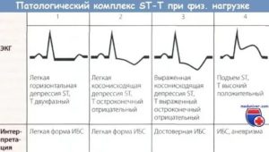 Можно ли делать кардиограмму во время месячных