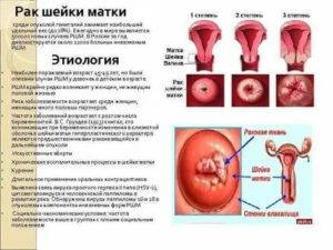 Что значит распад опухоли при раке шейки матки