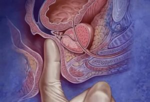 Suspicio tumor предстательной железы