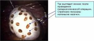 Когда начнутся месячные после лапароскопии яичников при поликистозе отзывы