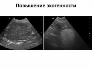 Что означает при узи матки повышенная эхогенность