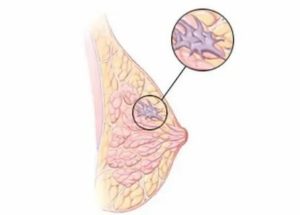 Какой самый опасный вид рака молочной железы