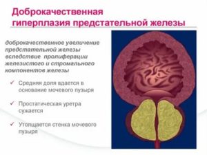Признаки хронического простатита гиперплазия периуретральных желез
