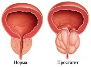 Можно ли пить кофе при простатите и аденоме простаты