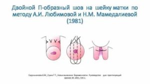 Как проходит операция по наложению шва на шейку матки