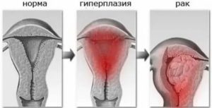 В чем разница между эндометриозом и гиперплазией эндометрия