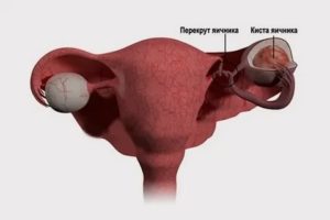 Почему образовывается в маточных трубах кисты