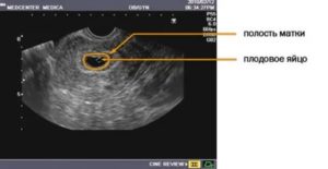 Узи матки при беременности на ранних сроках как проводят
