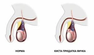 Сколько после операции сперматоцеле