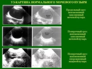 За сколько времени наполняется мочевой пузырь перед узи матки