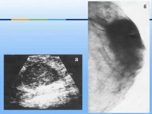 Гипоэхогенное образование в молочной железе это рак или нет