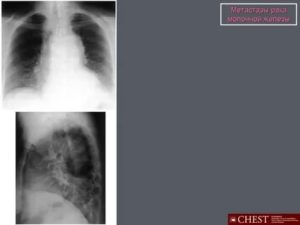 Метастазы в ребрах при раке молочной железы